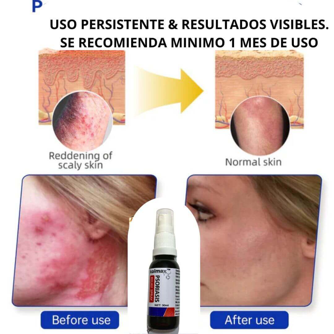 KOLMAX Spray Alivio Psoriasis SUPER OFERTA 2 X 70900