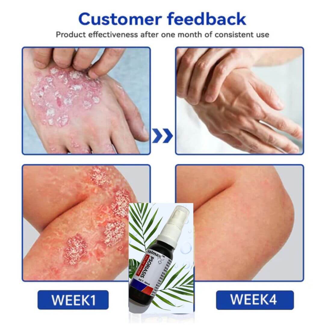 KOLMAX Spray Alivio Psoriasis SUPER OFERTA 2 X 70900