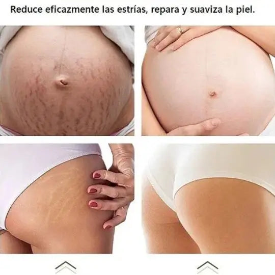 DERMARENEW Crema antiestrias de SkinCare