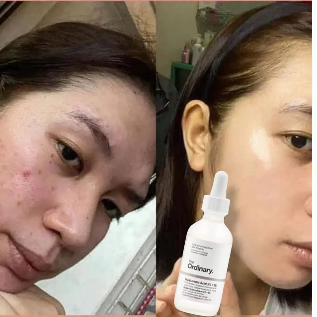 KIT NIACINAMIDA + RETINOL + ACIDO HIALURONICO THE ORDINARY