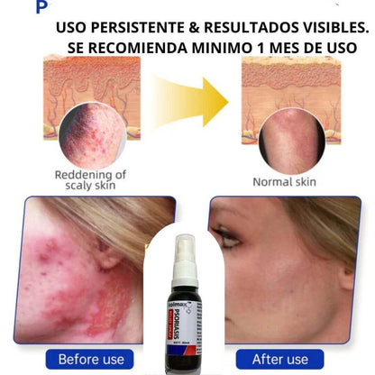 KOLMAX Spray Alivio Psoriasis SUPER OFERTA 2 X 70900