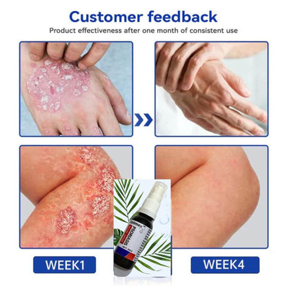 KOLMAX Spray Alivio Psoriasis SUPER OFERTA 2 X 70900